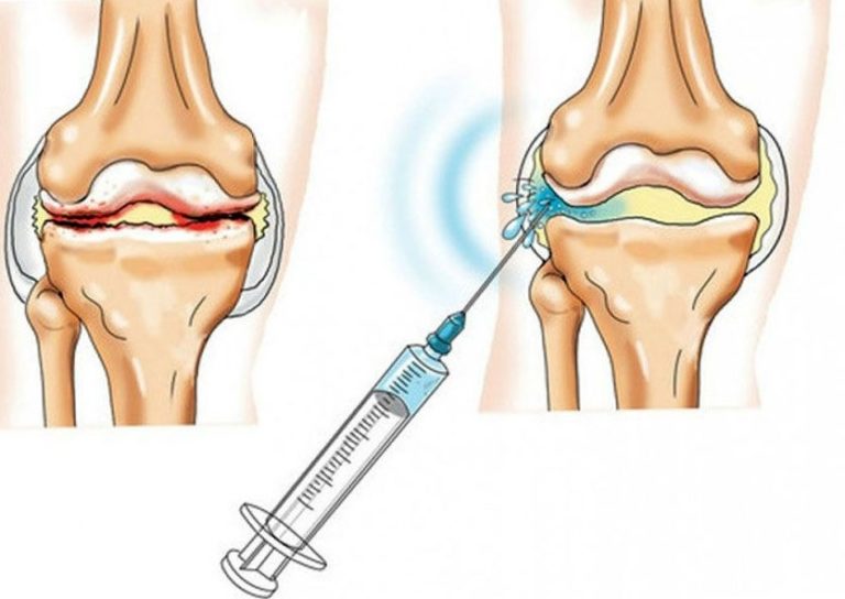 Внутрисуставные инъекции