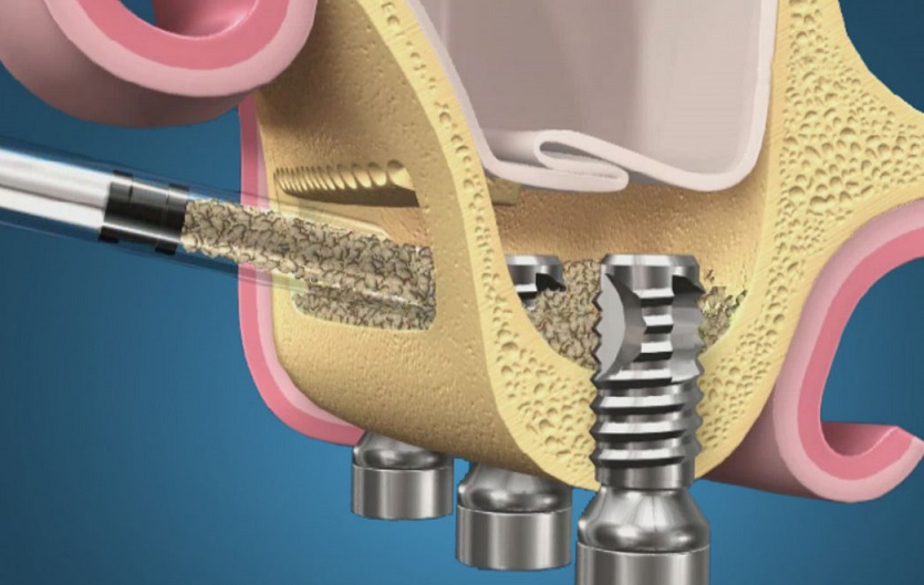 Дентальная имплантация - метод восстановления отсутствующих зубов