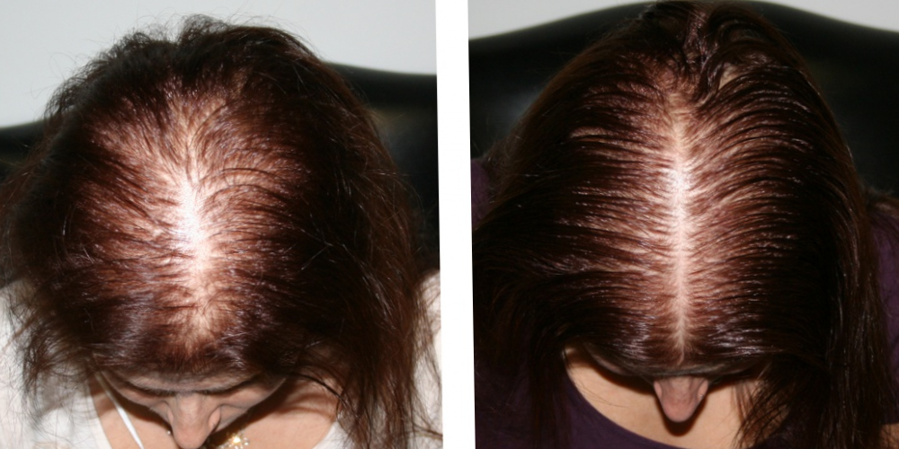 Плазмолифтинг волос - результат после 4 сеансов (2 месяца спустя)