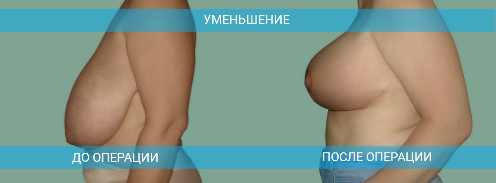 Уменьшение груди, вид до и после операции